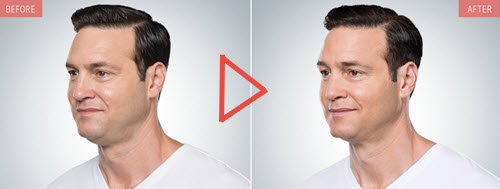 KYBELLA Information Video