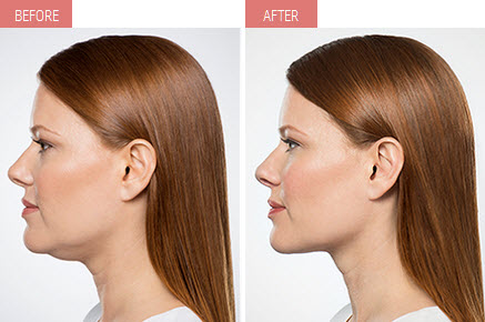 What exactly is KYBELLA?