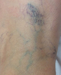 56-ex spider veins