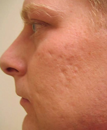 Before profractional 2