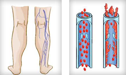 Deep Leg Vein Problems