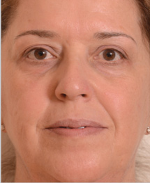 after profractional 1