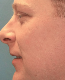 after profractional 2