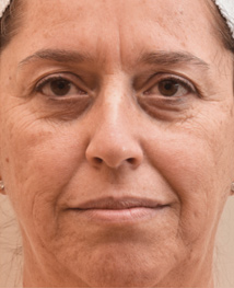 before profractional 1