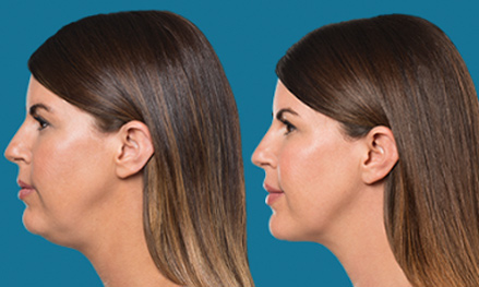 kybella before and after