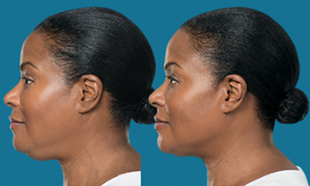 kybella before and after