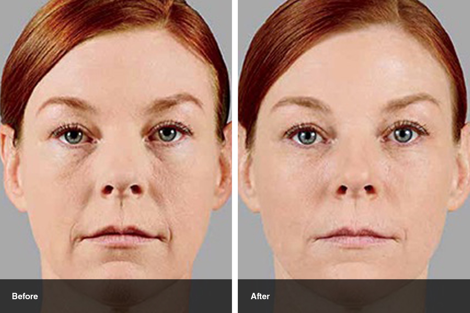 dermal fillers botox neuromodulators before after midwest vein and laser dayton 13