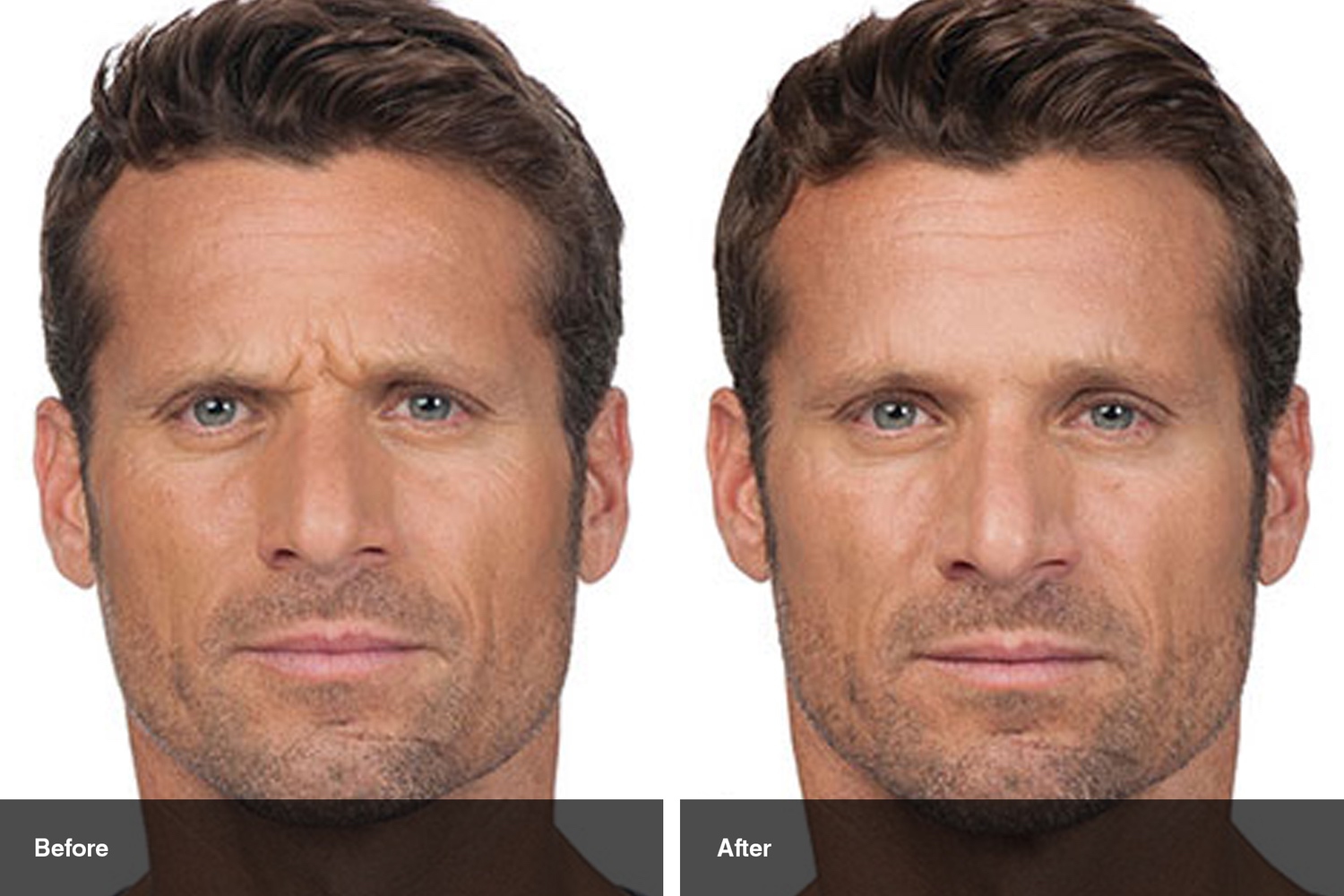 dermal fillers botox neuromodulators before after midwest vein and laser dayton 4