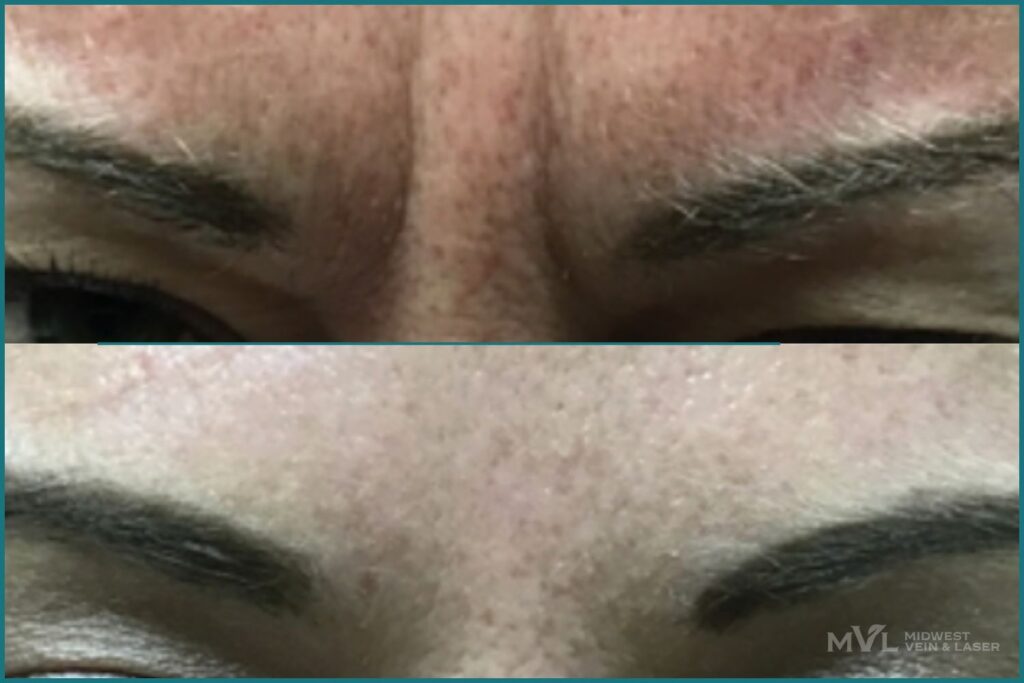 Botox MVL Before and After Treatment