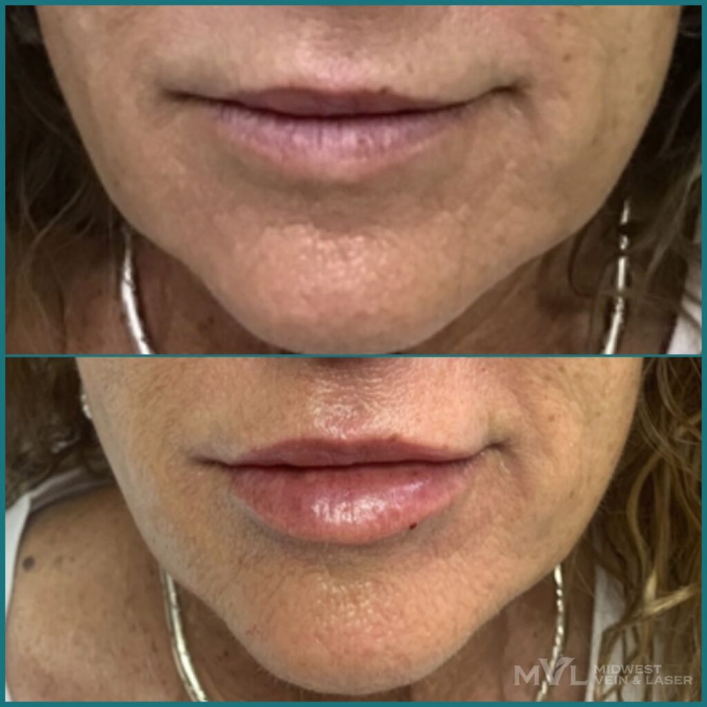 Lip Filler MVL Before and After Treatment