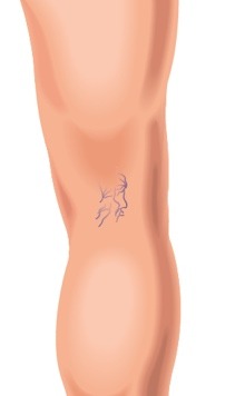spider veins graphic