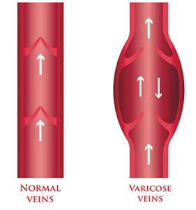 varicose-vein-illustration-MVL-281x300