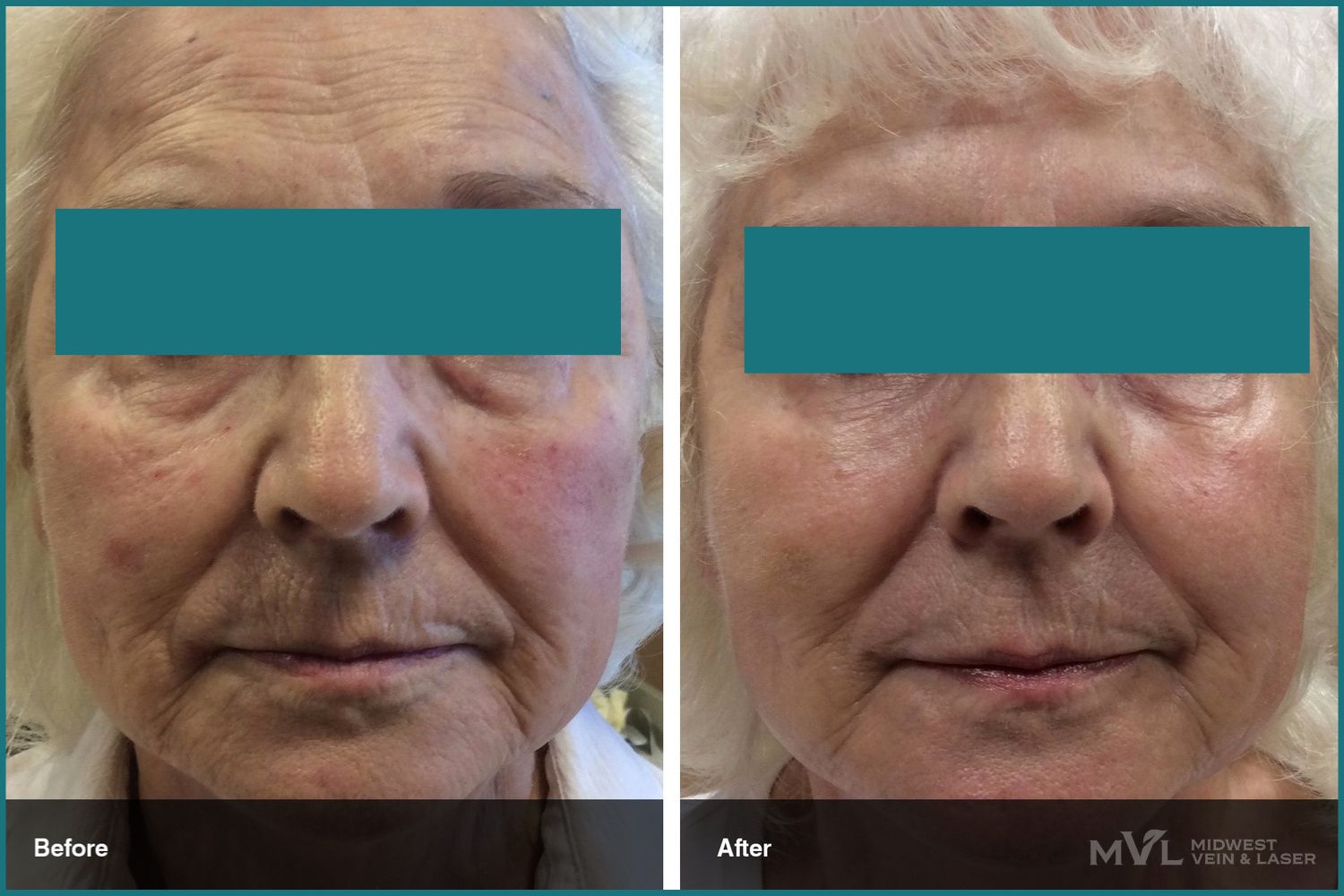 Dermal fillers before and after Midwest Vein and Laser patient